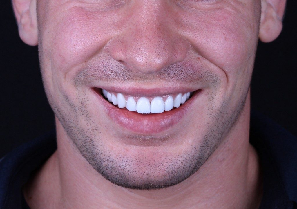 Man smiling and with veneers
