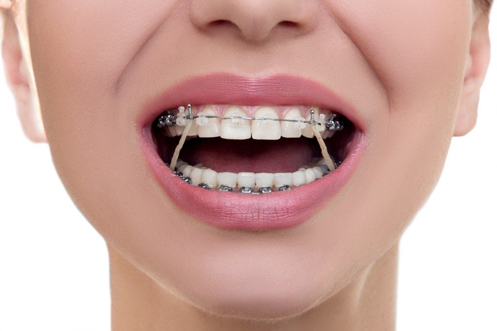 Teeth Straightening Options