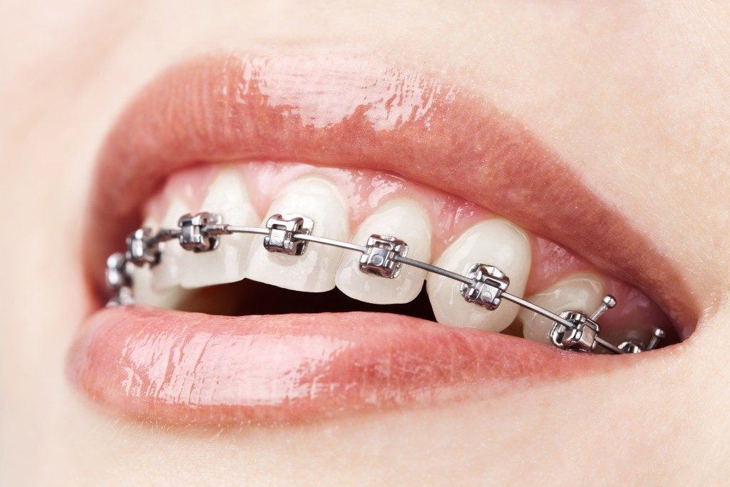 woman's teeth in braces