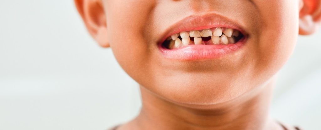 common teeth problems in children