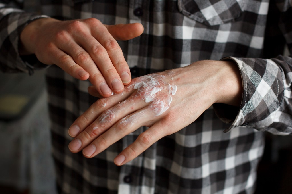 man applying ointment on hand